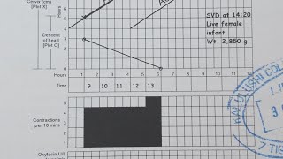 How to use a partograph step by step guide [upl. by Teirtza146]