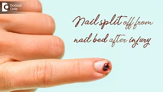 Nail split off from nail bed after injury  Tips by Dermatologist Dr Nischal K Doctors Circle [upl. by Arde]