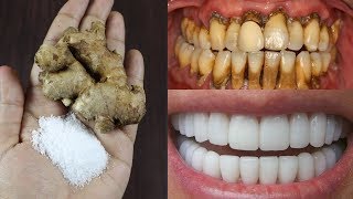 daant saaf karne ke nuskhe  Teeth Whitening [upl. by Netsuj]