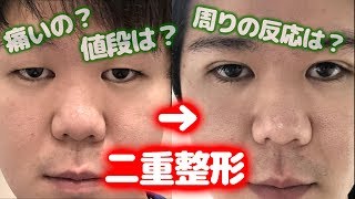 【男の整形】重たい一重の男が埋没3点法をやったらどうなる？ [upl. by Fergus433]