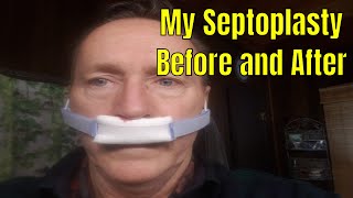 My nasal splint removal [upl. by Frisse308]