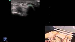 3D How To Ultrasound Exam of the Guyons Canal  SonoSite Ultrasound [upl. by Cecelia]