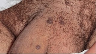 HPV em homens Conheça os sintomas causas prevenção tratamento [upl. by Shir]