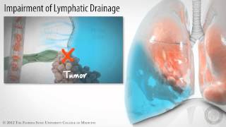 Pleural Space Part 3 of 3 Pleural Effusions HD [upl. by Evelina]