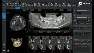 LargeV Dental Analysis Software How LargeV Al simulated implanting [upl. by Siesser]