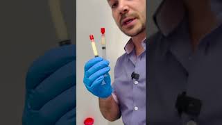 Biofiller How to convert PRP into most natural filler for rejuvenating and revolumize the face [upl. by Lytle]