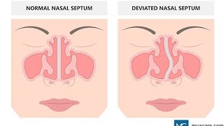 Deviated Nasal Septum deviatednasalseptum dns nose nostril apnea snoring nosebleeds trending [upl. by Plafker]