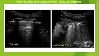 Syndrome alvéolaire shred sign en échographie [upl. by Nois]