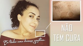 ♿ Eu tenho uma doença rara e não tem cura  Neurofibromatose1  Pós Lesão Medular 5EP [upl. by Eselahs]