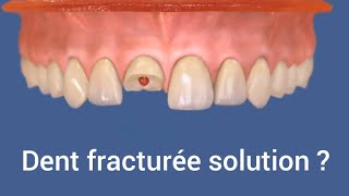 Dent fracturée solution  réparation dent cassée devant par la résine composite [upl. by Steel]