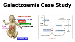 Galactosemia Case Study  Classical Galactosemia  NEXT PG Biochemistry [upl. by Neitsirhc804]