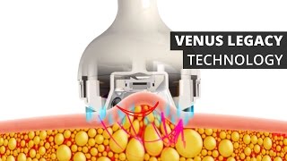 Venus Legacy™ Technology [upl. by Leyla]