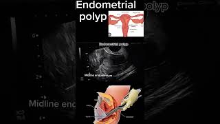 Endometrial Polyp Case Study A StepbyStep Diagnosis health ultrasound polyp DrSaimakhan [upl. by Nwahser591]