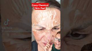 Crazy CHEMICAL PEEL  Anti Aging Peel Before and After shorts [upl. by Lunna337]