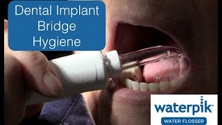 Implant Bridges  Cleaning For Longterm Success [upl. by Eiramannod]