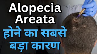 आयुर्वेद के हिसाब से बालो में कीड़ा क्यो लगता है  Causes of Alopecia areata according to Ayurveda [upl. by Pomona]