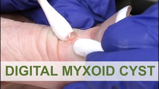 We love a Digital Myxoid Cyst  Dr Derm [upl. by Yddeg580]