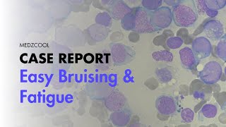 Easy Bruising amp Fatigue  Case Report  MEDZCOOL [upl. by Dorrehs]