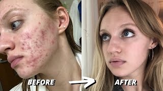 HOW I CLEARED 7 YEARS OF SEVERE ACNE  ACCUTANE JOURNEY [upl. by Eanram]