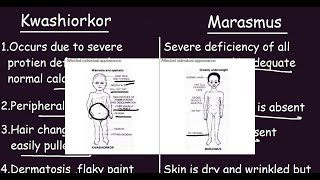 Kwashiorkor vs Marasmus Quick Differences amp Comparison [upl. by Ytineres711]