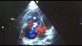 Right ventricular dualthrombi attaching to the chordae tendineae a case report [upl. by Damick429]