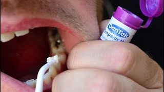 How To Fix a Broken Tooth with Dentemp or DenTek Tooth Filling and Crown Repair [upl. by Husha]