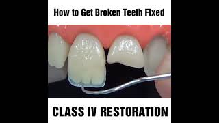 How to fix a chipped cracked or broken tooth MyDentCart  Cracked tooth repair  Broken Tooth [upl. by France367]