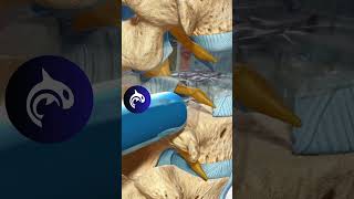 See how a TLIF relieves back pain and restores spinal stability with a 3D Animation [upl. by Livy]