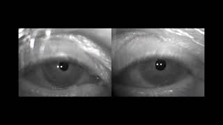 Eye motor abnormalities in Wernicke encephalopathy case 2 [upl. by Yknip317]