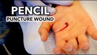 HE STABBED HIS HAND WITH A PENCIL puncture wound  Dr Paul [upl. by Nosduh]