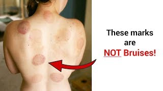 A Word About Cupping Marks  Cupping Bruises Explained [upl. by North183]