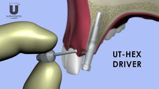 Biodent Ultratooth Animation [upl. by Kelwunn]