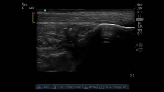 Achilles Tendon Rupture US Annotated JETem 2019 [upl. by Ahsaf618]