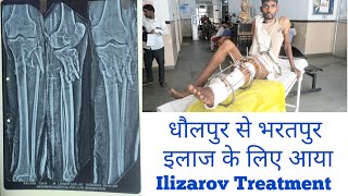 TIBIA FIBULA OPEN FRACTURE ILIZAROV TREATMENT ilizarovsurgery fracture [upl. by Chickie]