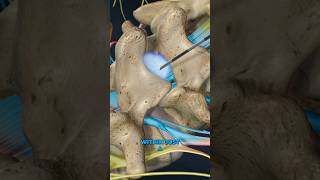 Lumbar Epidural Steroid Injection 3D Animation [upl. by Gally696]