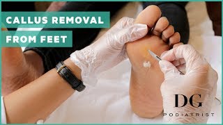 Callus removal from feet balls of feet [upl. by Aiker]