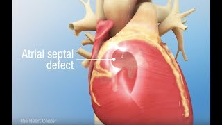 Understanding Pleural Effusions [upl. by Ahsilek]