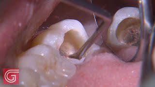 HOW TO Clean Up Severe Occlusal Decay on TOOTH 31 1 of 2 [upl. by Nilyahs263]