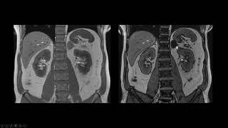 Adenoma adrenal [upl. by Aelgna]