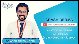 4  MYCOBACTERIAL INFECTIONS شرح الجلدية الجزام والدرن دعبدالرحمن رضا [upl. by Gad]