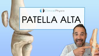 Patella Alta  Expert explains Diagnosis Assessment and Treatment [upl. by Lener548]