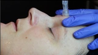 DermaStamp Treatment [upl. by Sedinoel]