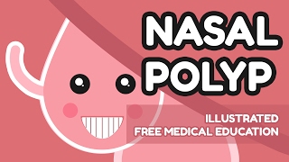 What is Nasal Polyp [upl. by Ahsoym]