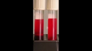 اخطاء عند سحب عينه الدم Effects of Hemolysis on Clinical Specimens [upl. by Teague]