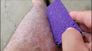 Purple Pumice vs Psoriasis Skin Flakes [upl. by Eniroc733]