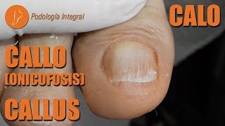 Callus on big toe Podología Integral podologiaintegral [upl. by Notyarb]