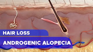 Hair Loss Androgenic Alopecia [upl. by Hesler]