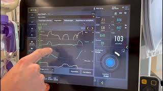 Het berekenen van de occlusie druk en predicted transpulmonaal druk ServoU [upl. by Maxine]