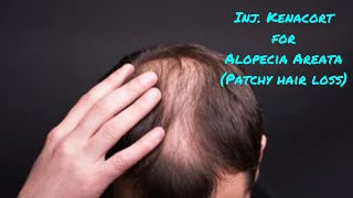 Kenacort Injection for Alopecia Areata Treatment  Patchy Hair Loss [upl. by Pascal555]