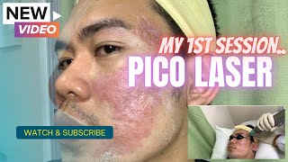 My First Session with Pico Laser Treatment [upl. by Ranit420]